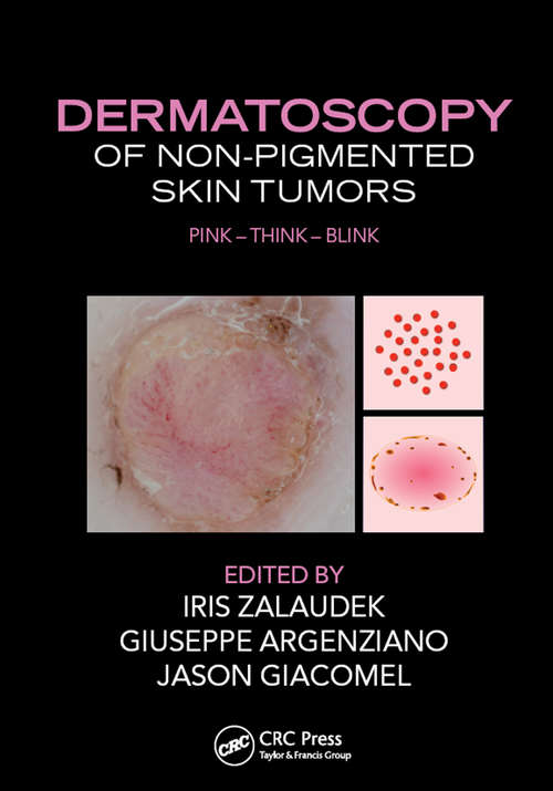 Book cover of Dermatoscopy of Non-Pigmented Skin Tumors: Pink - Think - Blink