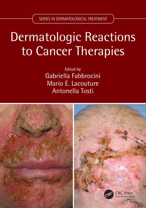 Book cover of Dermatologic Reactions to Cancer Therapies (Series in Dermatological Treatment)