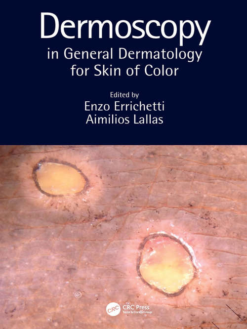 Book cover of Dermoscopy in General Dermatology for Skin of Color