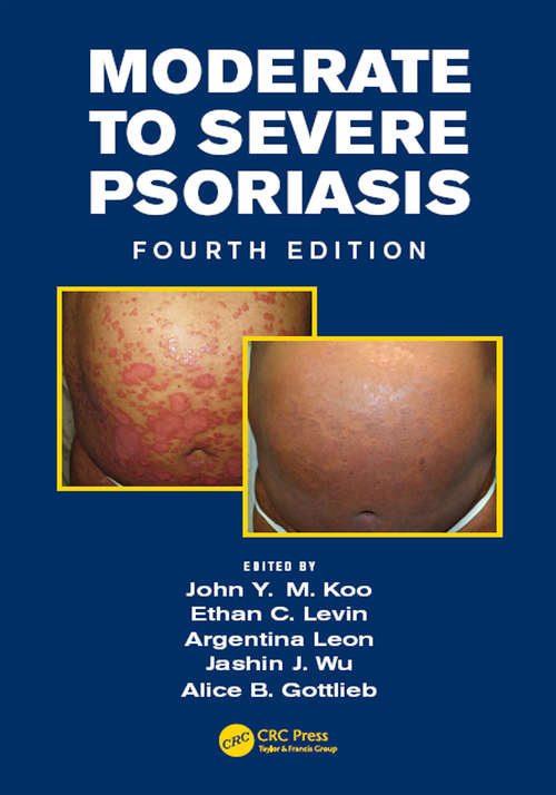 Book cover of Moderate to Severe Psoriasis (4)