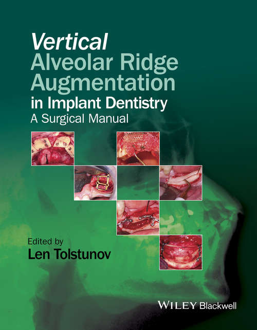 Book cover of Vertical Alveolar Ridge Augmentation in Implant Dentistry: A Surgical Manual