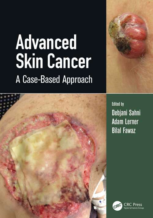 Book cover of Advanced Skin Cancer: A Case-Based Approach