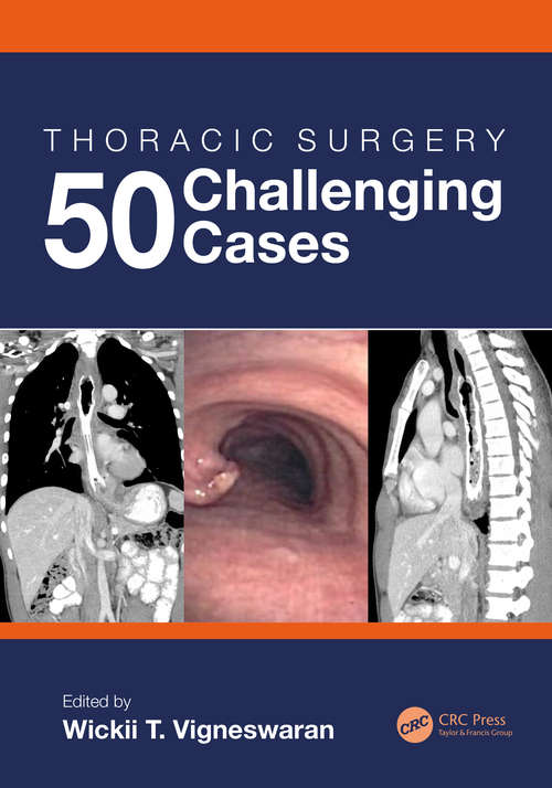 Book cover of Thoracic Surgery: 50 Challenging cases