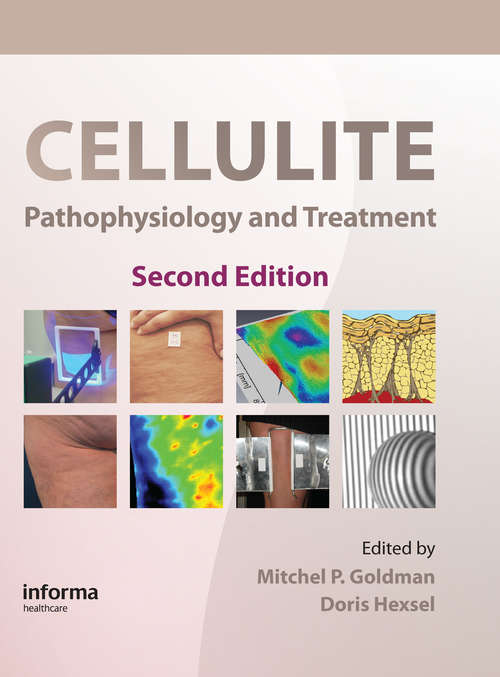 Book cover of Cellulite: Pathophysiology and Treatment (2)